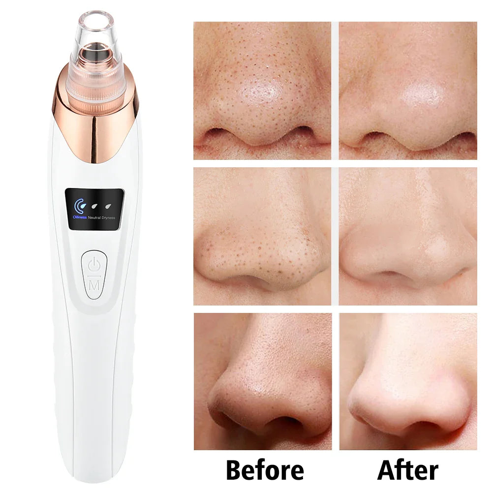 Derma Suction Blackhead Removal Machine 4 in 1